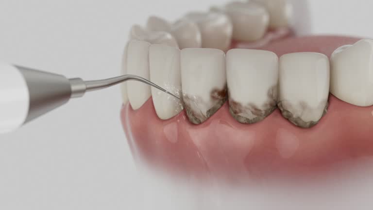 Trusted Dental Implants service in Crawfordsville, IN - Dentist Open Now